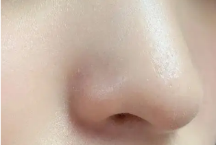 卸妆水去黑头有效果吗 卸妆水能去黑头吗？